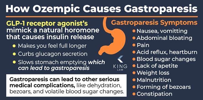 This infographic describes how GLP-1 receptor agonists work and how they may cause stomach paralysis. A list of gastroparesis (stomach paralysis) symptoms is shown. Silhouette of a stomach shown. 