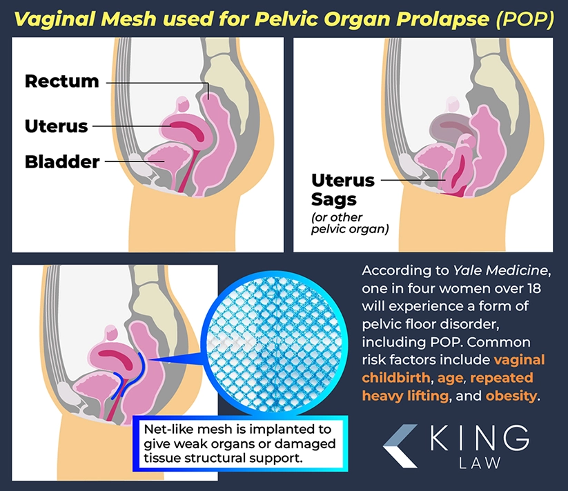 This infographic shows where and how vaginal mesh is used in the body. It also notes who is at the highest risk of pelvic floor disorders.